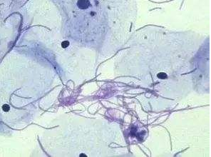 阴道分泌物香蕉视频下载安装厂家探讨白带清洁度3代表什么意思