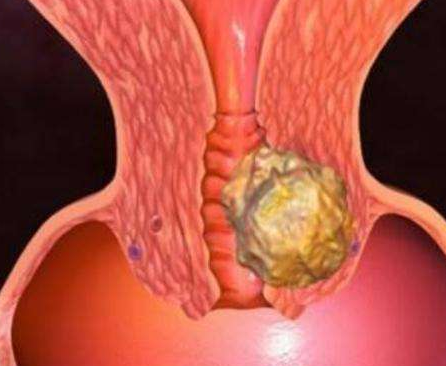 阴道分泌物香蕉视频下载安装厂家分析阴道分泌物多的原因