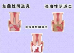 全自动阴道分泌物香蕉视频下载安装厂家提醒您还在拖延吗，还在等阴道炎自愈吗？