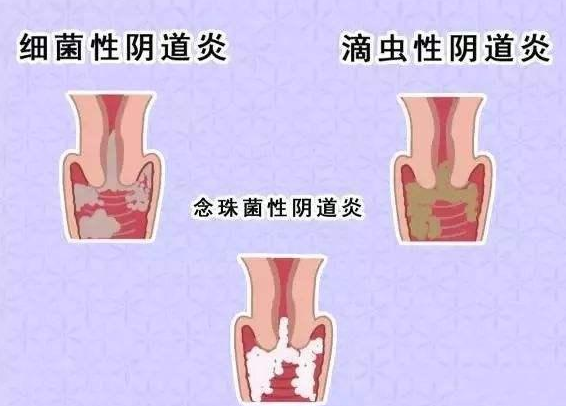 全自动阴道分泌物香蕉视频下载安装厂家提醒您还在拖延吗，还在等阴道炎自愈吗？